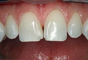 East Windsor Dental Arts | Laser Dentistry, CBCT and Zoom Whitening